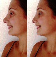 Before And After Surgery On Nose Sacramento, California Pic