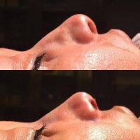 Before and after rhinoplasty surgery In Texas