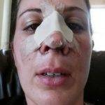 Beverly Hills, CA Nasal Surgery Recovery Photo