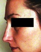 Chandler Arizona Plastic Surgery Nose Tip Involves Altering The Cartilage And Bone Structure Of The Nose