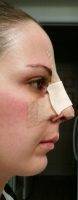 Cornwall UK Cosmetic Nasal Surgery if you've had an accident or injury that's left nose looking distorted