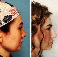 Cosmetic Nasal Surgery is a surgical procedure used to modify or correct the shape of the nose