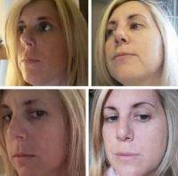 Cosmetic Rhinoplasty In Lakewood New Jersey Can Change The Shape Of The Nasal Tip