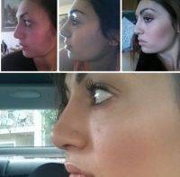 Cosmetic Surgery Of Nose In Harley Street And Guildford