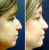 Cosmetic Surgery Of Nose In Houston, TX beaked nose before after