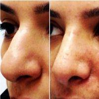 Detroit MI Nose Rhinoplasty Before And After