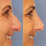 Dr Pham Cosmetic Surgery Of Nose Perth Before And After