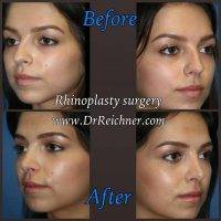 Dr Reichner Rhinoplasty Photo Creating Symmetry By Removing Any Nasal Imperfections