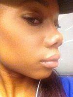 Dr. Lam Cosmetic Surgery Rhinoplasty in Dallas, TX on African American Nose