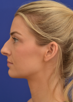 Dr. Roth Tip Of The Nose Surgery is performed to improve the appearance and breathing function of the nose