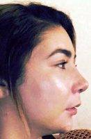 Good Nose Shape In San Diego After Rhinoplasty