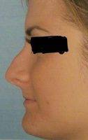 Good Rhinoplasty In Hamilton Involves Reshaping The Nasal Bones And Cartilages
