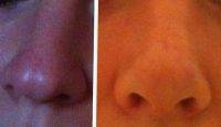 Illinois Cosmetic Surgery Nose Before And After