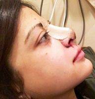 Large Nose Rhinoplasty In San Diego, CA Is Usually Performed Under General Anesthesia