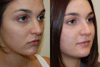 Los Angeles Nose Job Before And After Photos