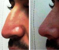 Male Nose Shape Surgery in UK Pictures Before And After