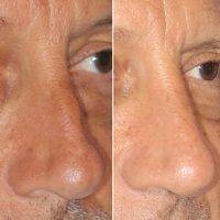 Male Rhinoplasty In Philippines Before And After