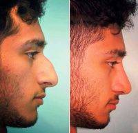 Male Rhinoplasty In Vancouver