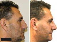 Male Rhinoplasty Nose Surgery In Los Angeles Pics Before And After