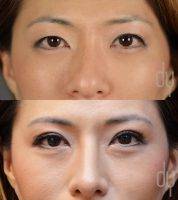 Miami Asian Rhinoplasty And Upper Blepharoplasty 2 Months Post Op