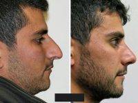 Miami Plastic Surgery Rhinoplasty For Man Before And After