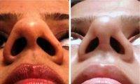 Newark Rhinoplasty Pictures Before After