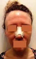 Nose Beauty Surgery Can Improve Breathing Through The Nose