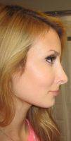 Nose Beauty Surgery Improved Facial Profile