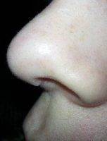 Nose Beauty Surgery In Sacramento, CA Can Change The Size Of Your Nose