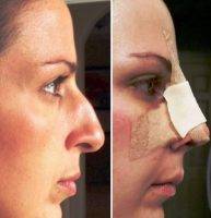 Nose Beauty Surgery In United Kingdom To Reshape The Nose