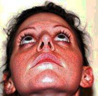 Nose Cosmetic Surgery For Aesthetics And For Breathing