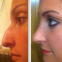 Nose Job In Melbourne, Victoria Before And After