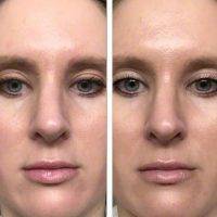 Nose Job In Seattle Before After Photos