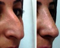 Nose Job In Toronto, ON For The Better Size, Shape And Skin Quality Of Your Nose