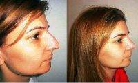 Nose Job In Tucson Arizona Before And After