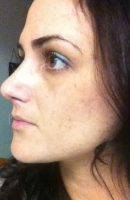 Nose Job Is A Surgical Procedure That Is Performed To Permanently Change The Shape And Size Of The Nose