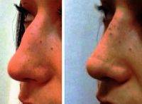 Nose Job Is Consistently One Of The Top Three Most Frequently Performed Plastic Surgery Procedures Mesa Arizona
