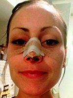 Nose Job Plastic Surgery Houston, Texas To Correct Imperfections