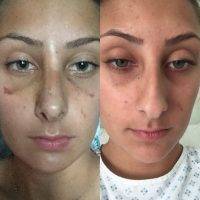Nose Job Procedure In Seattle, WA Before And After Picture