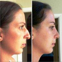 Nose Job Surgery Tampa Before And After