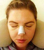 Nose Op In Avondale Arizona Is An Extremely Delicate Procedure