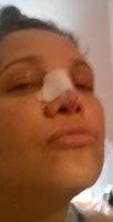 Nose Plastic Surgery Illinois Results By Dr. Sidle
