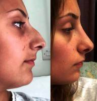 Nose Refinement Surgery In London By Mr Miles Berry