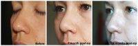 Nose Reshaping Rhinoplasty Can Improve The Size, Shape, And Overall Appearance Of Your Nose