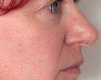 Nose Shape Surgery In Cherry Hill Can Produce A Balanced And Harmonious Nose That Blends With The Person's Facial Features
