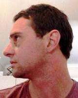 Nose Surgery For Man In Caloocan Philippines For Enhancing Facial Harmony And Self-confidence
