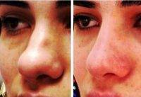 Nose Tip Plastic Surgery Provo UT Pic