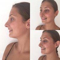 Perfect Nose For Oval Face In Leicester By Rajan Uppal, MBBS, FRCS