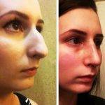 Perth, Western Australia Cosmetic Surgery Rhinoplasty Before And After Photos