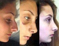 Plastic Surgery Nose Illinois Before And After Pics